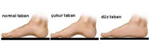 Çocuklara Düz Taban Hastalığı